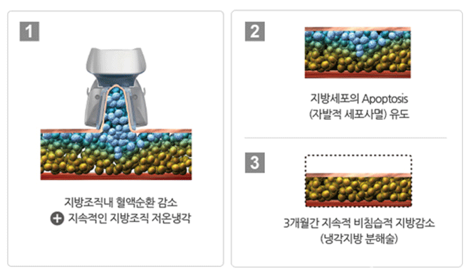 냉각지방분해술의 원리